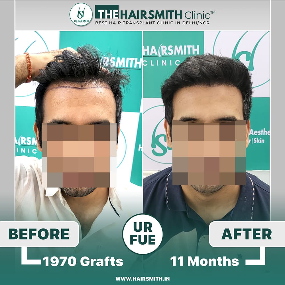 The Hairsmith Clinic Hair Transplant Result - Before and after result 1
