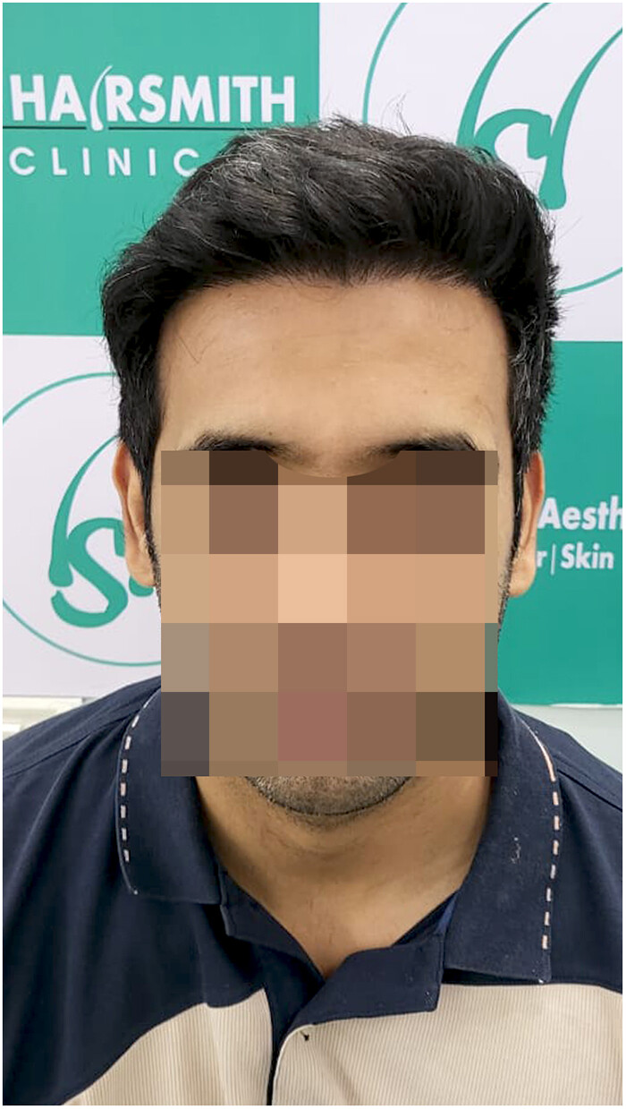 hairsmith clinic - 11 months hair transplant result - 1