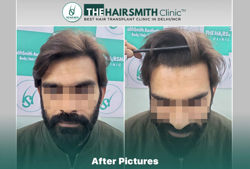 after hair transplant result - the hairsmith cliic delhi #hairtransplant #hairlinehairtransplant #hairsmithtransplantrdelhi